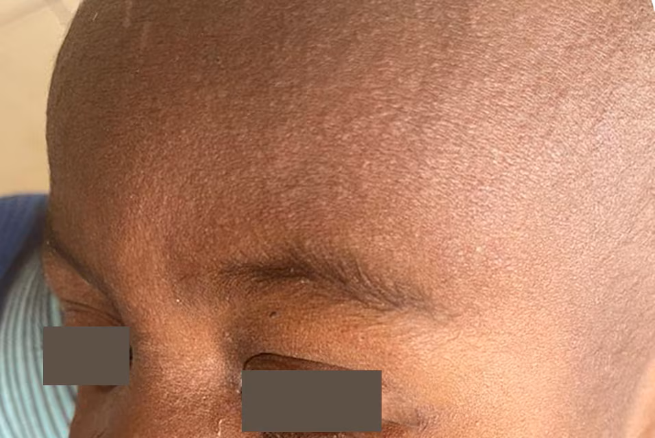 Examples of a measles rash on the forehead